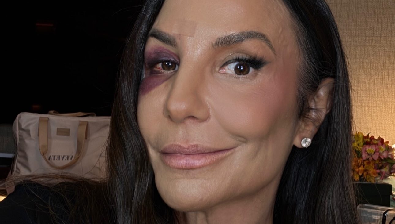 Ivete Sangalo dá detalhes de acidente doméstico em que fraturou ossos da face